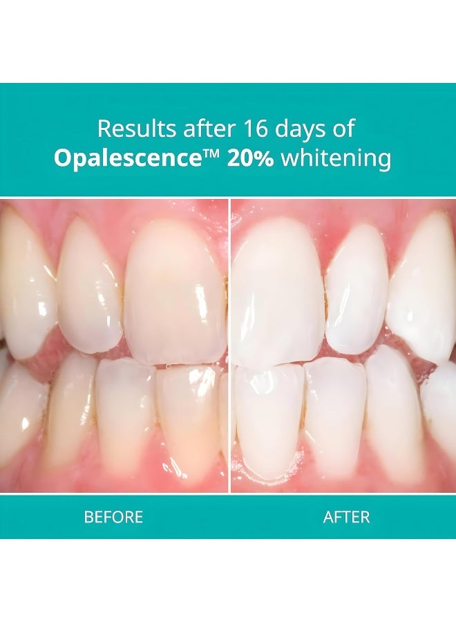 ULTRADENT Opalescence 20% Teeth Whitening Refill Kit (2 Packs / 4 Syringes) Carbamide Peroxide - Image 4